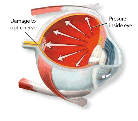 Glaucoma