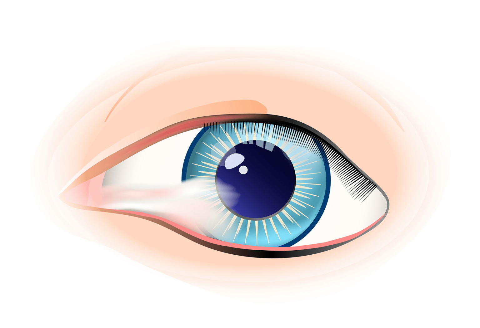 Main Cause Of Pterygium Know As "Surfer’s Eye" | Linda Vision