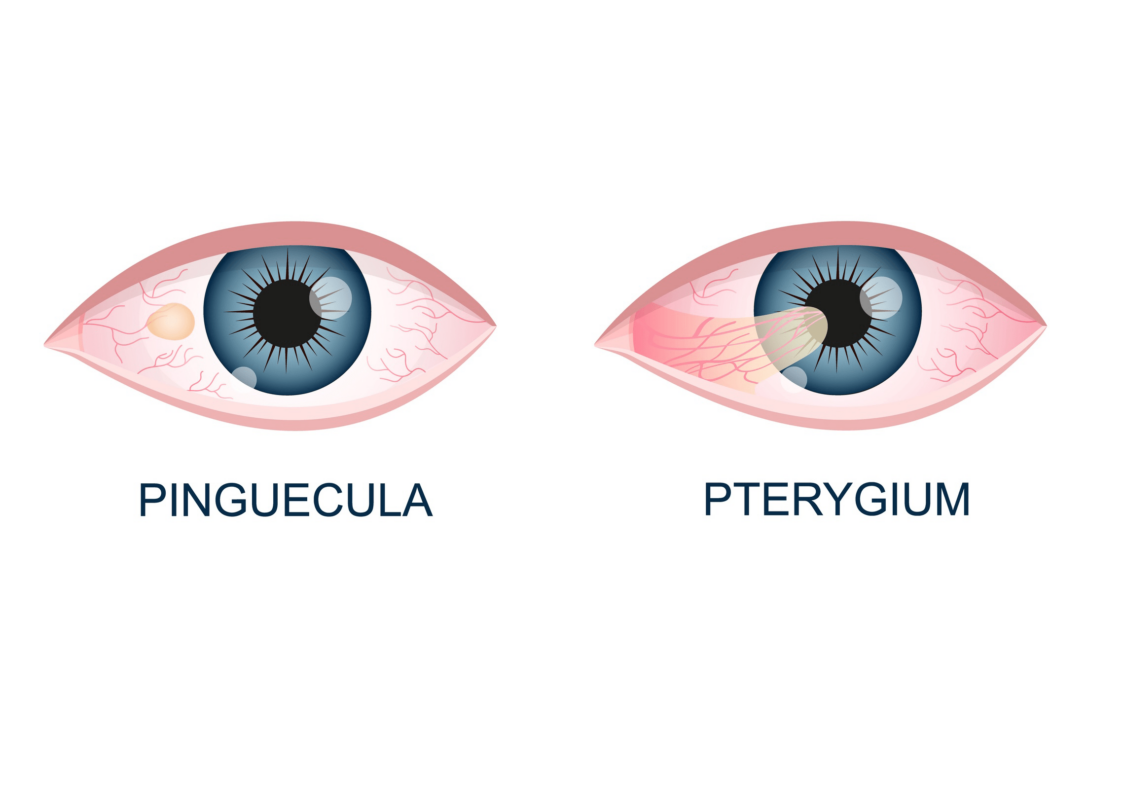 Afecciones oculares por pinguécula y pterigión