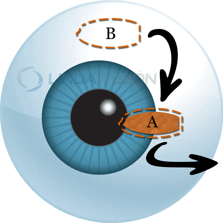Pterygium Surgery Monterey Park CA